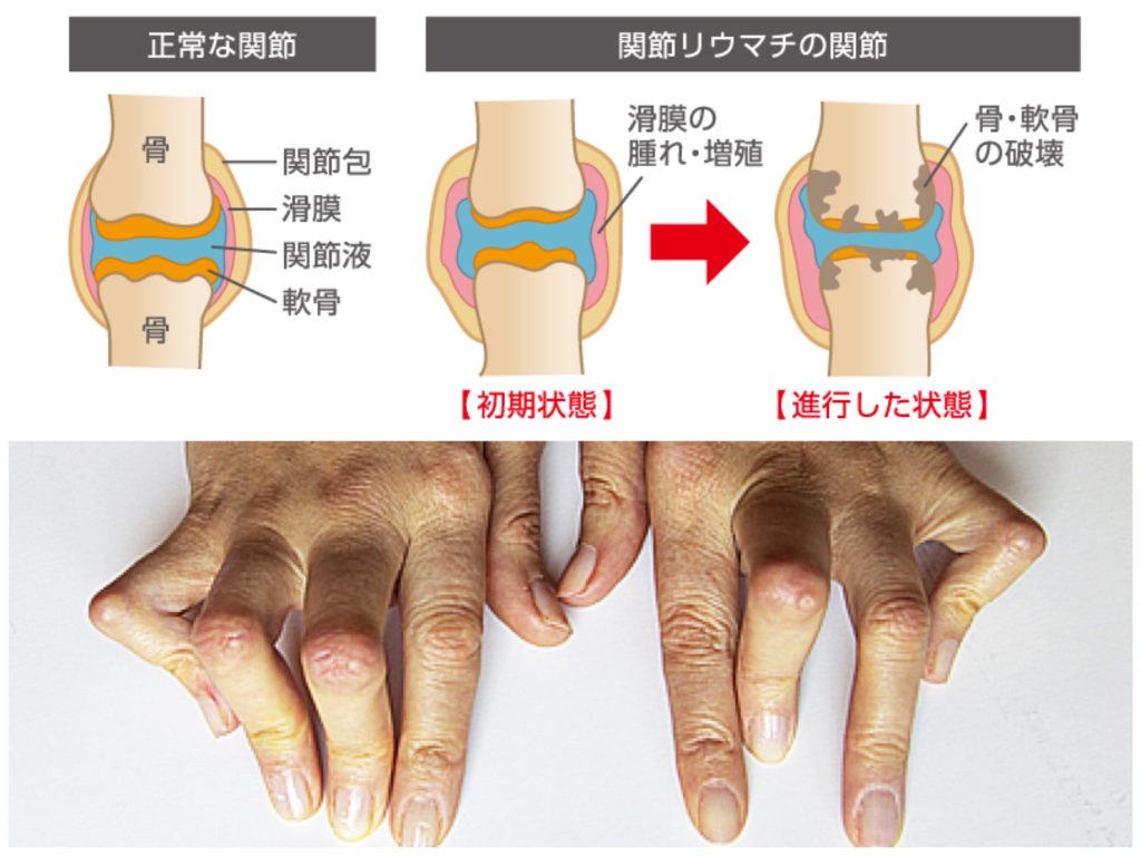 関節リウマチの手術はどの程度成功していますか?
